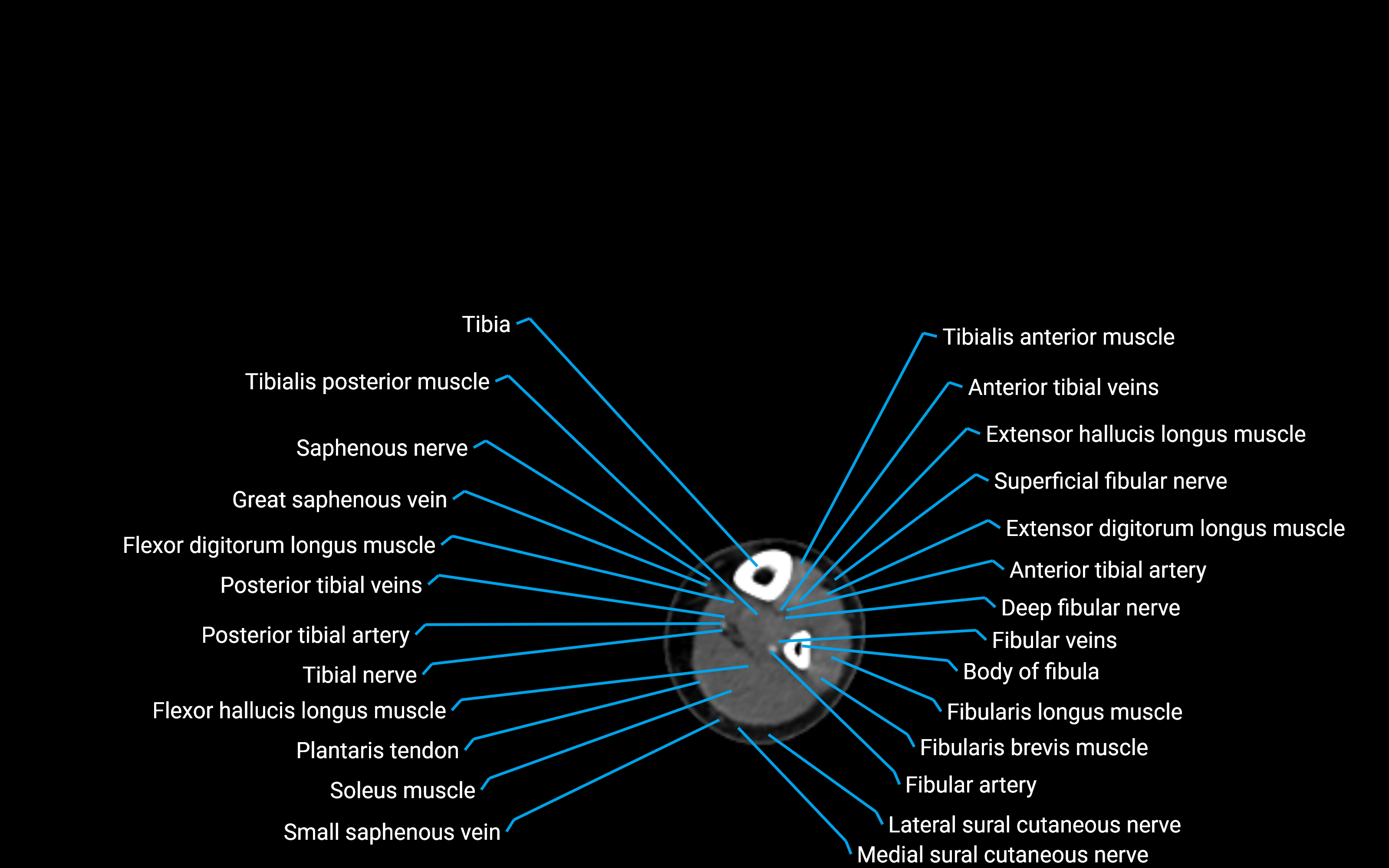 CT Lower leg axial cross sectional anatomy labelled image 139 (2).png